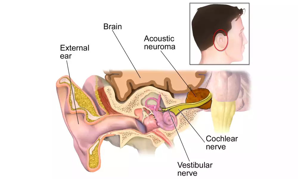 neuroma