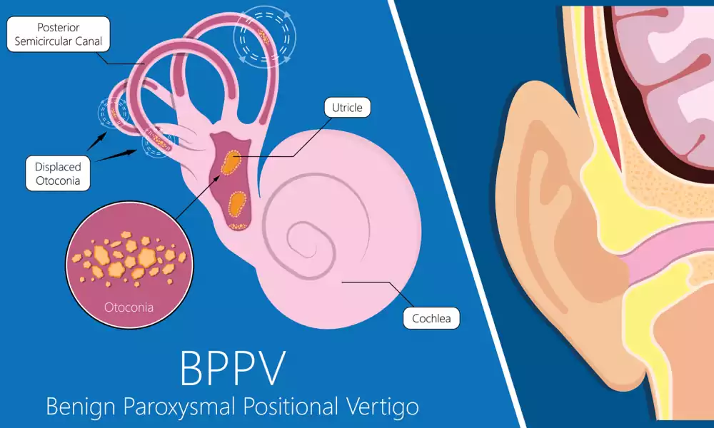 bppv