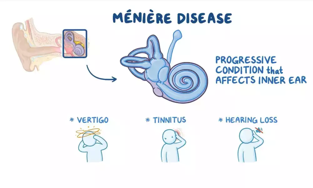 menieere
